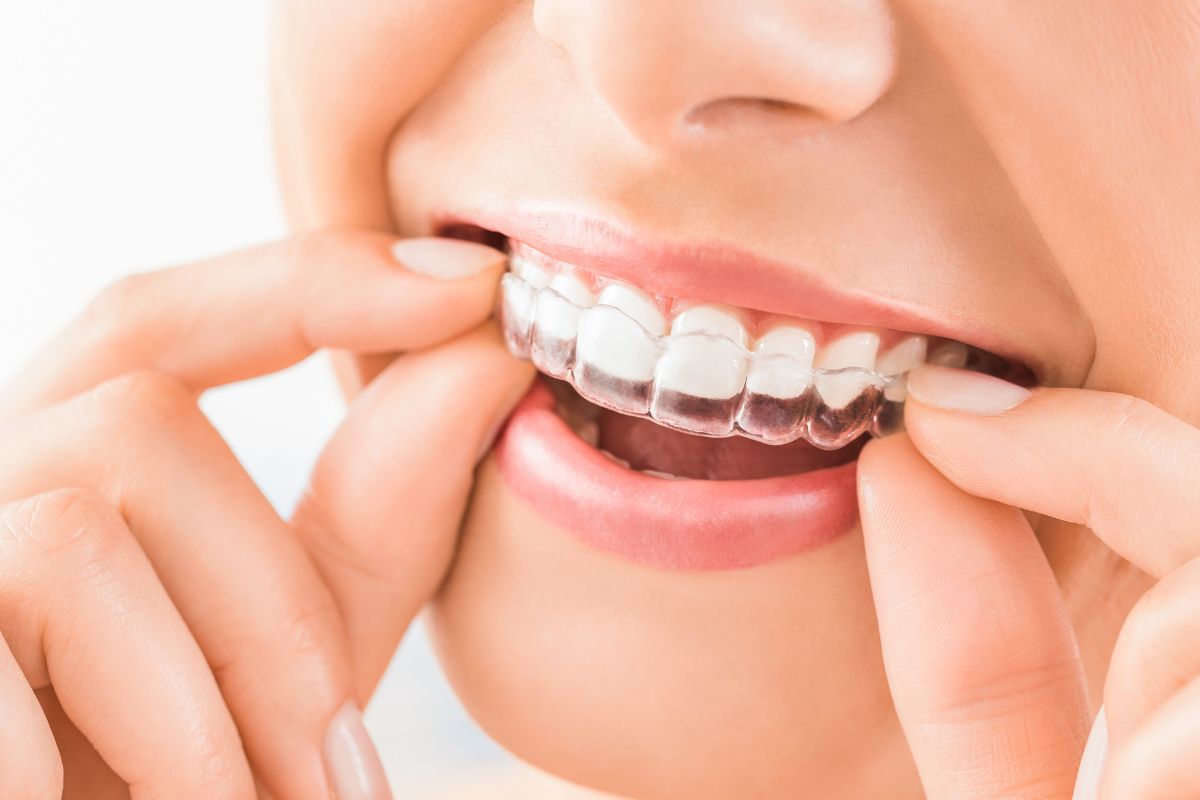 Transparent Aligners- Taylorsville Implant Center | Dr. Jose Hernandez