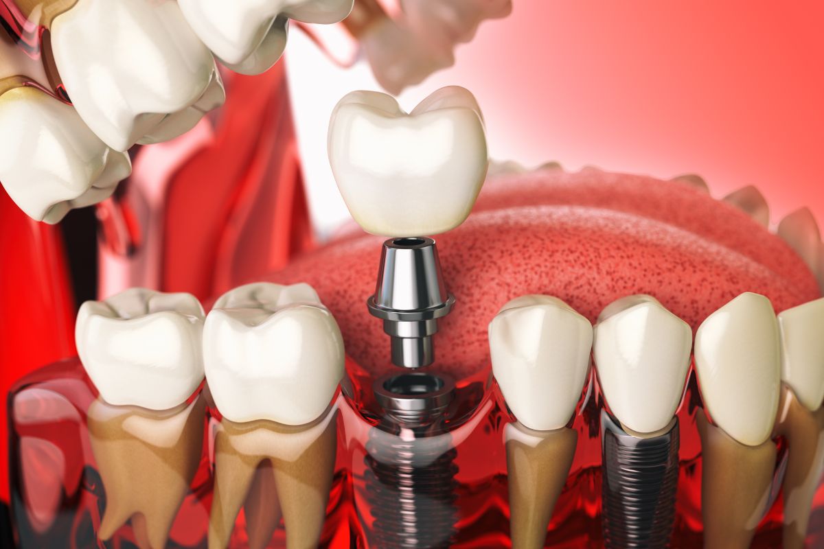 Dental Implants Treatment- Taylorsville Implant Center