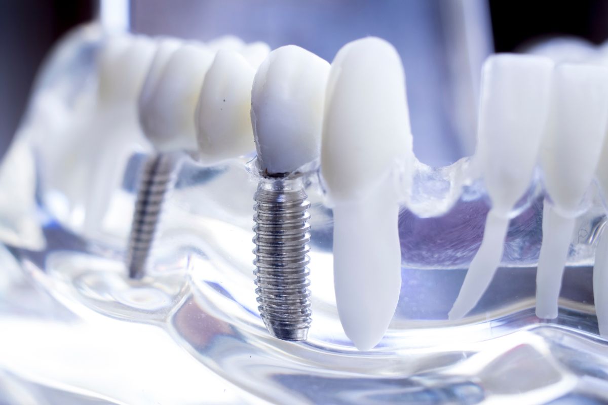 General Dentistry Implants Service- Taylorsville Implant Center | Dr. Jose Hernandez