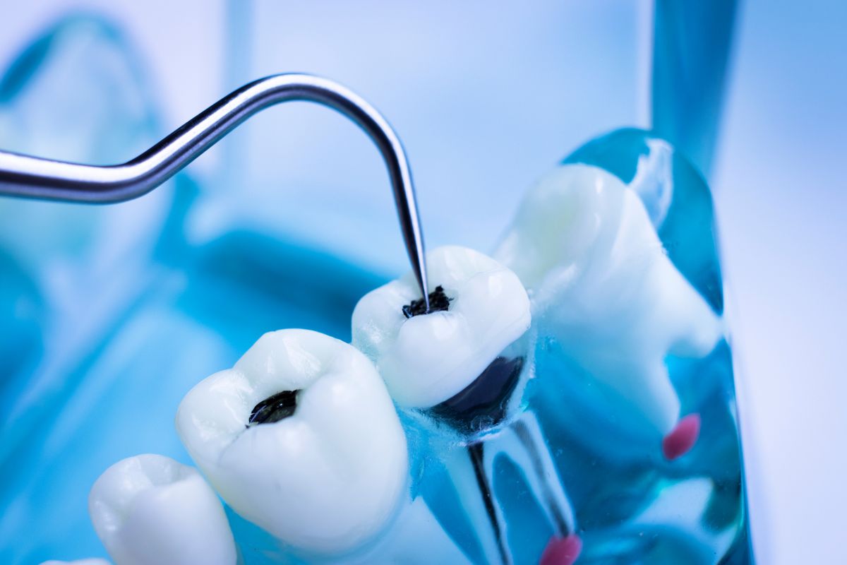 Dental Cavity Treatment- Taylorsville Implant Center | Dr. Jose Hernandez Gil